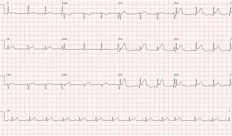 Twelve-lead ECG of patient presented to the ER with chest pain ...