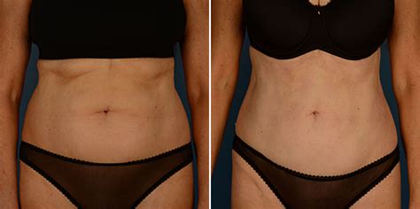 Vaser Liposuction Photos Naples Fl Patient