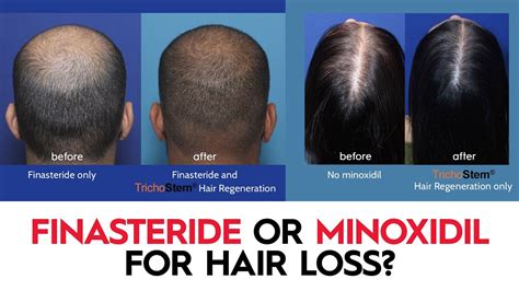 Which Is Better Minoxidil Or Finasteride For Hair Loss Youtube