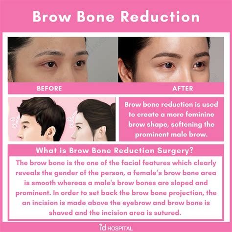 prominent brow ridge testosterone 1
