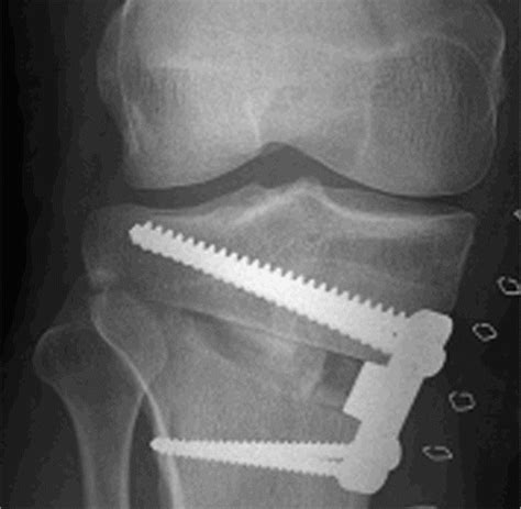 Full Article Opposite Cortical Fracture In High Tibial Osteotomy