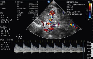 Transcranial Doppler Ultrasound In Neurocritical Care Radiology Key