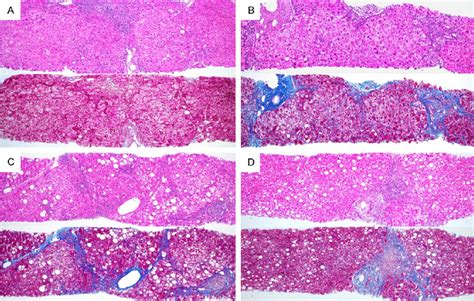 Liver Steatosis Histology