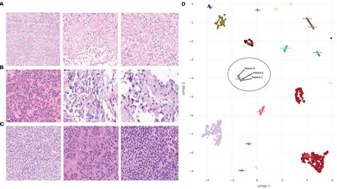 Frontiers Heterogeneous Clinicopathological Findings And Patient