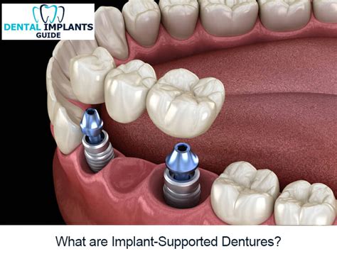 What are Implant-Supported Dentures?