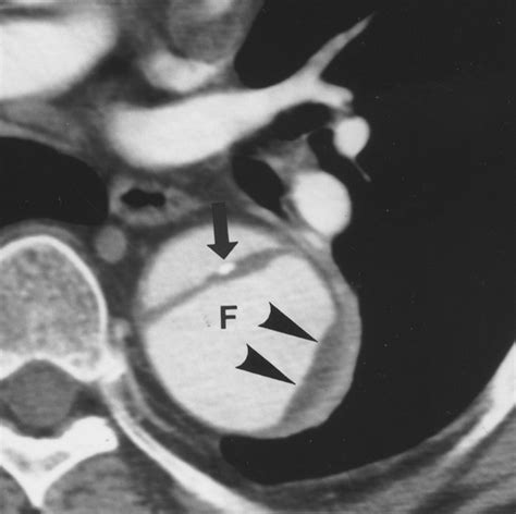 Aortic Dissection Ct Features That Distinguish True Lumen From False