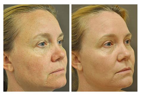 Fractional CO2 Laser Skin Resurfacing - Wrinkles, Sun Damage - San Diego