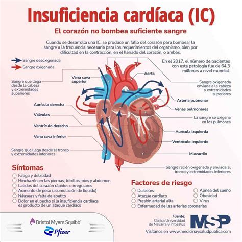 Insuficiencia Cardíaca Infografía