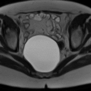 Magnetic Resonance Imaging Showing X X Cm Presacral Cyst