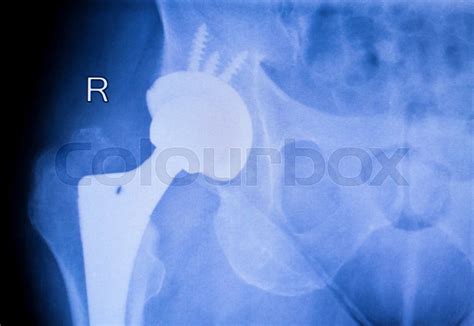 Hip replacement xray orthopedic medical scan | Stock image | Colourbox