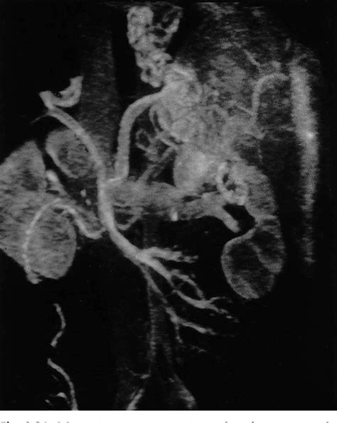 The Hepatic Artery Portal Venous System And Portal Hypertension The