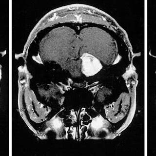 T Weighted Magnetic Resonance Mr Images Showing A Hyperintense