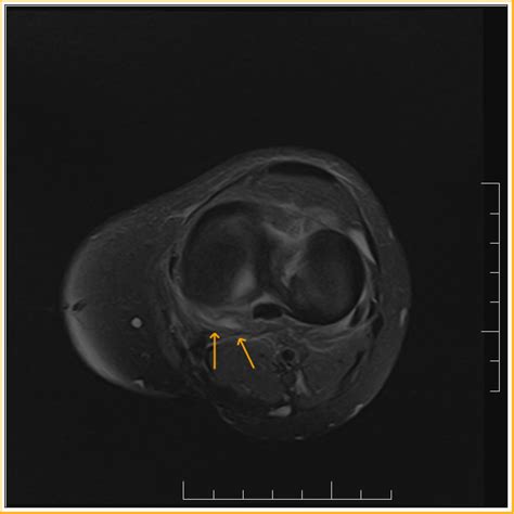 Posteromedial Corner Injury MRI Sumer S Radiology Blog