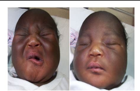 Figure 1 From Congenital Asymmetric Crying Face With Bilateral Microtia