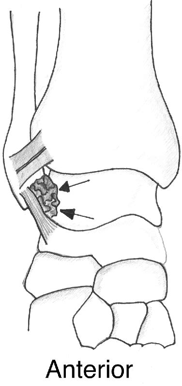 Figure 5 From Mr Imaging Of Impingement And Entrapment Syndromes Of The