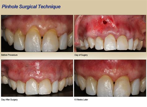 Receding Gums Surgery Before And After