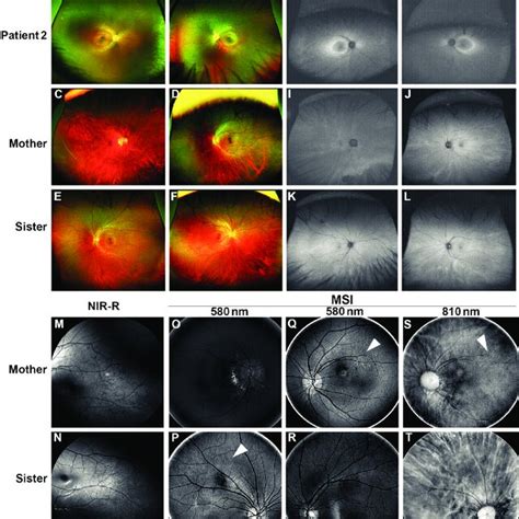 Multimodal Imaging Of The Patient 2 And Carriers A B Pseudocolour