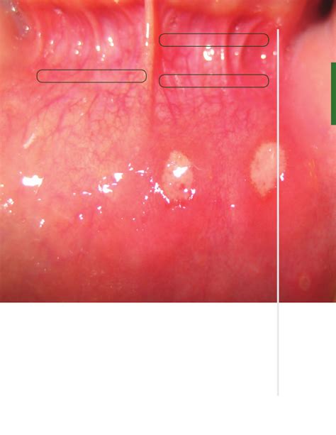 Aphthous Stomatitis Aphthous Ulcer Causes Aphthous 42 Off