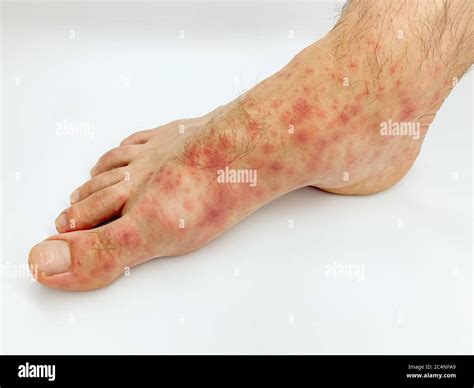 Red Rash On Foot Outlet Emergencydentistry