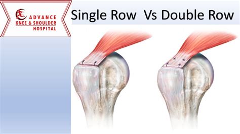 Single Row Vs Double Row Debate Orthopedic Surgeons YouTube