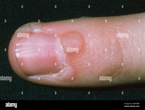 Wart Close Up Of Warts Growing Around The Nail On A Finger Warts Are