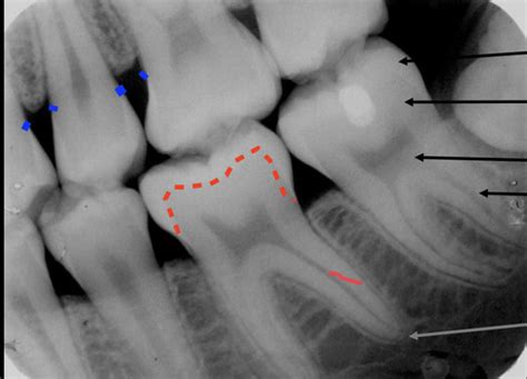 Teeth And Supporting Structures Radiographs Flashcards Quizlet