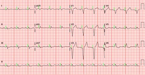 Dr. Smith's ECG Blog: A patient with a ventricular paced rhythm and chest pain