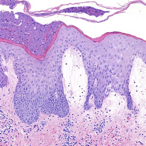 Acute Generalized Exanthematous Pustulosis Agep From The Patient