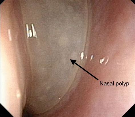 Endoscopic Sinus Surgery Dr Jeeve Ent Specialist