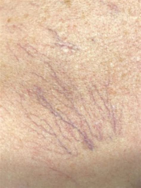 Laser Vein Removal Before After Photos Patient Reno Med Spa