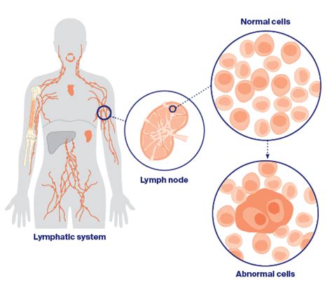 Lymphoma Hodgkin's Disease - Hodgkin lymphoma | Cancer Council NSW