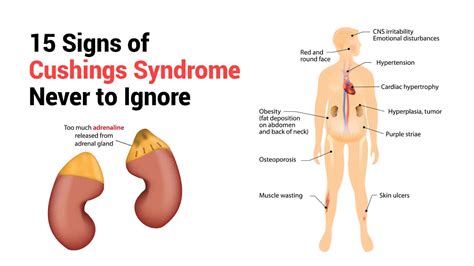 Understanding Cushing Syndrome Causes Symptoms And Off