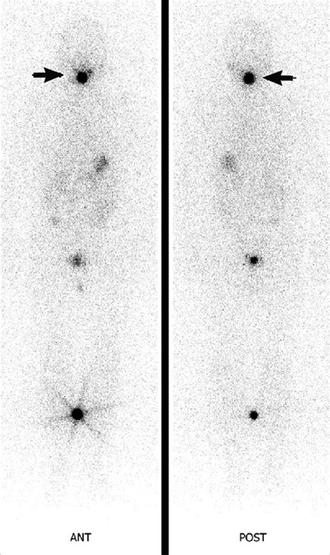 131 I Whole Body Scan Anterior And Posterior 131 I Whole Body Scan