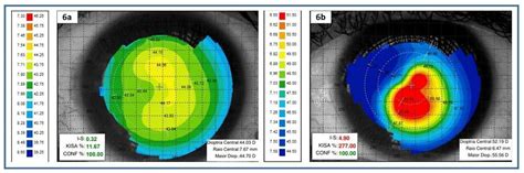 Ceratocone Diagn Stico E Tratamento