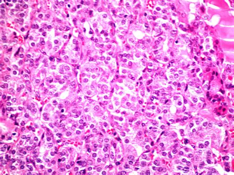 Pathology Outlines - Follicular carcinoma