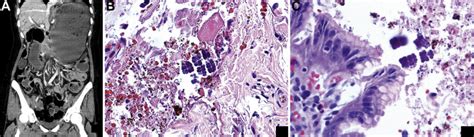 Sarcina Ventriculi In A Patient With Slipped Gastric Band And Gastric