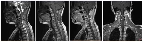 Atypical Meningioma With Destruction Of Cervical Vertebrae Inside The