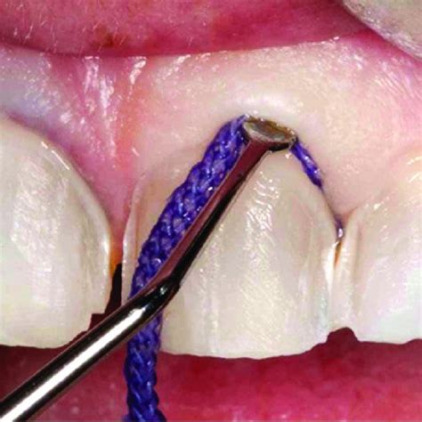 Pdf The Place Of Retraction Cords Among The Tissue Displacement Methods