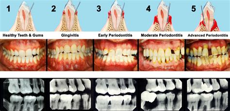 Gum Disease Bayview Village Dental North York Willowdale York Mills