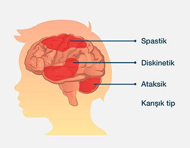 Serebral Palsi Nedir Turan Turan