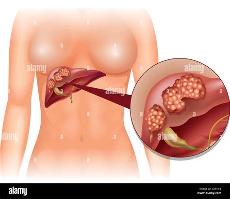 Liver Cancer Diagram In Detail Illustration Stock Vector Image And Art Alamy