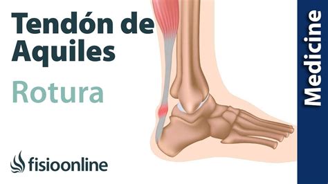 Rotura Del Tend N De Aquiles Diagn Stico Y Tratamiento De Fisioterapia