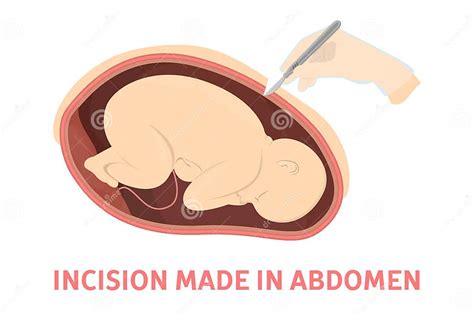 Incision Making Stage Of Birth Via Cesarean Section Stock Vector Illustration Of Gynecologist