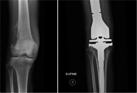 Plain X‐ray of the right tibia before and successful cadaveric bone ...