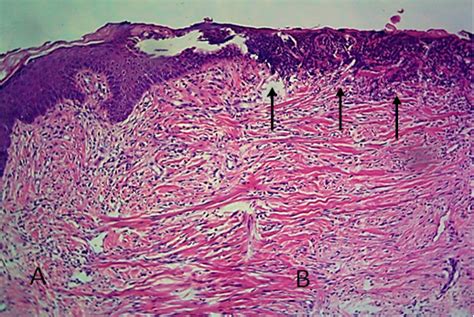 Granulation Tissue Histology