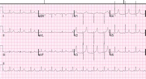 Dr. Smith's ECG Blog: Hyperkalemia and ST Segment Elevation, Post 1