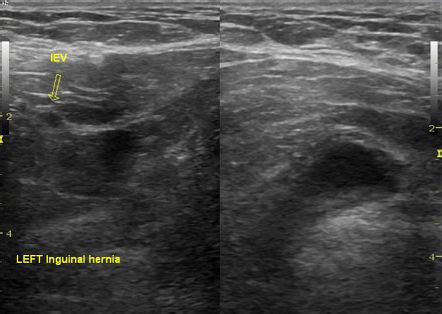 Urinary Bladder Hernia Radiology Case Radiopaedia Org