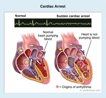 Cardiac Arrest; Causes, Types And Treatment. - INFORMATION NIGERIA