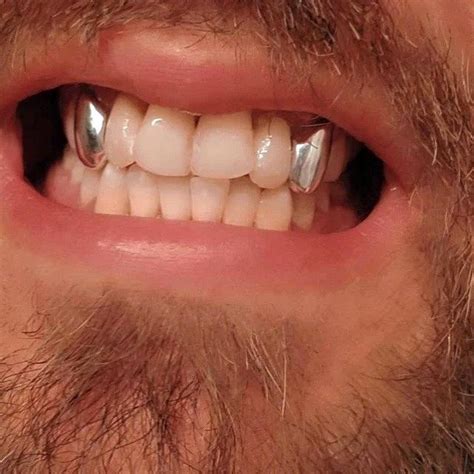 925 Sterling Silver Custom Canine Teeth Caps