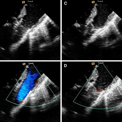 Intracardiac Echocardiography ICE Images A Two Dimensional ICE In